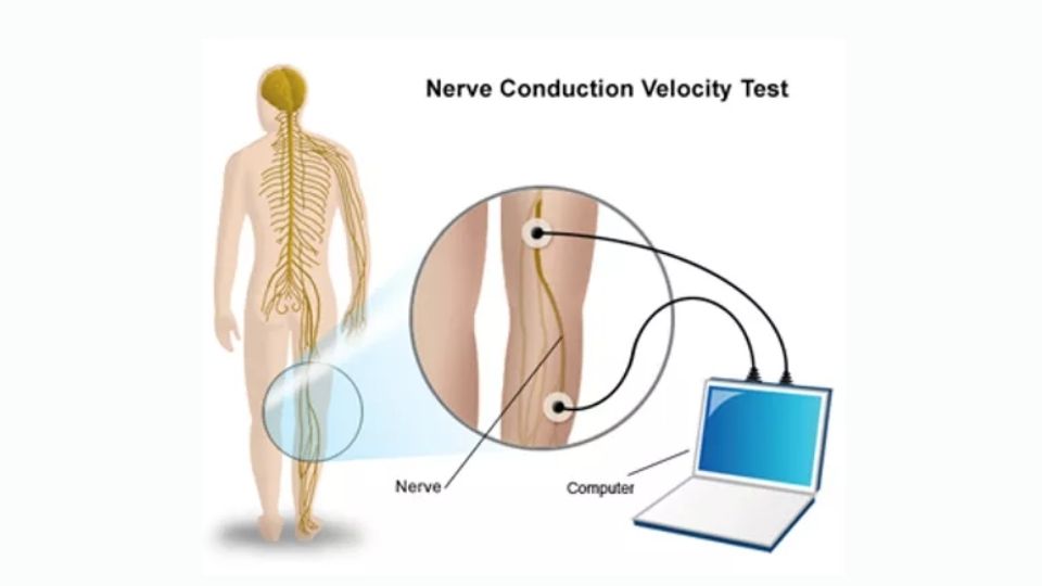 Nerve Conduction Test